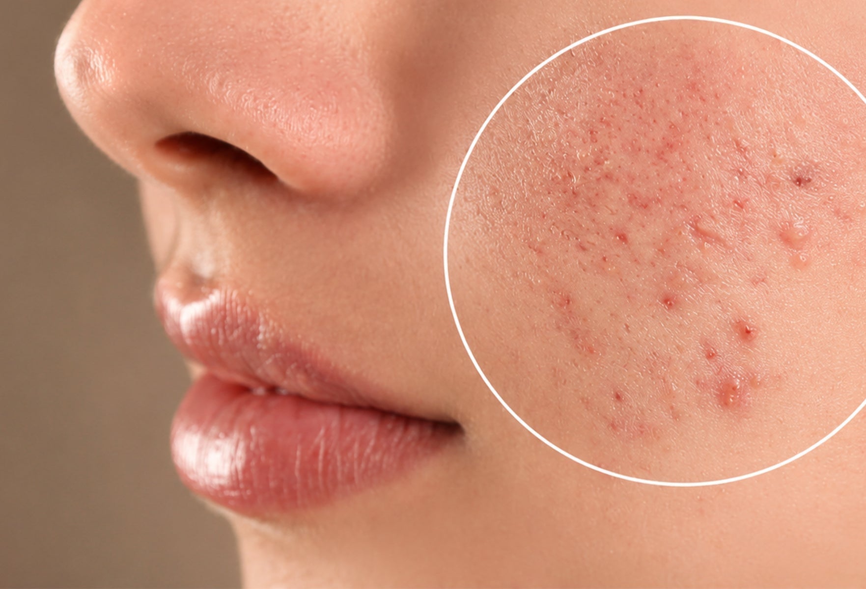 Why does skin breakouts in the monsoon season. – GHAR SOAPS