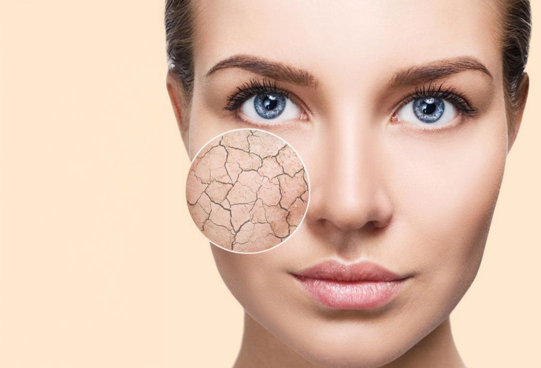 How to deal with dry, flaky skin this winter