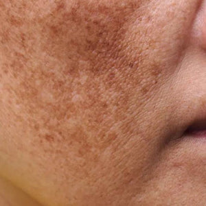 Pigmentation
